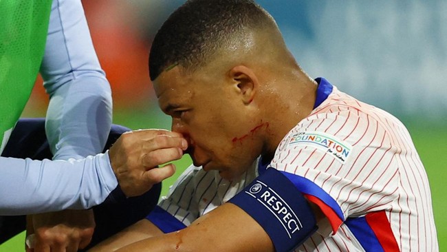 Hidung Mbappe Patah Saat Prancis Menang atas Austria, Terancam Absen di Sisa Euro 2024?